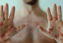 Mpox avança em Rondônia: veja quem são os 16 pacientes confirmados