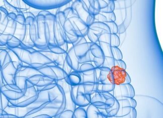 SUS adotará exame não invasivo para identificar câncer de intestino